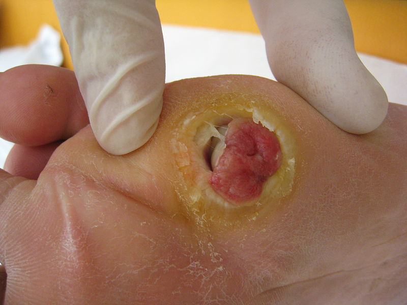 File:Diabetic Wound 121.jpg